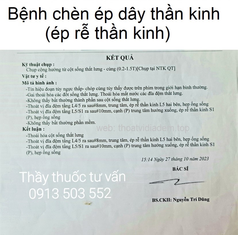 Bệnh chèn dây thần kinh